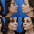 Why Health Consultants Recommend SMAS Facelift For Facial Rejuvenation In NY
