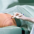 Liposuction Facts From A Health Consultant In Las Vegas