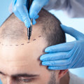 Navigating Hair Restoration: How A Health Consultant Can Guide You Through FUT Transplantation In The Bay Area