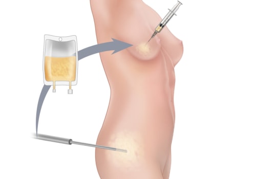 Unlocking Your Body's Potential: How A Health Consultant Can Enhance Your Fat Grafting Experience In Scottsdale